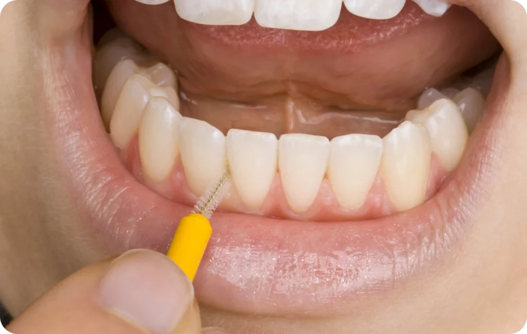 Extraction dents de sagesse