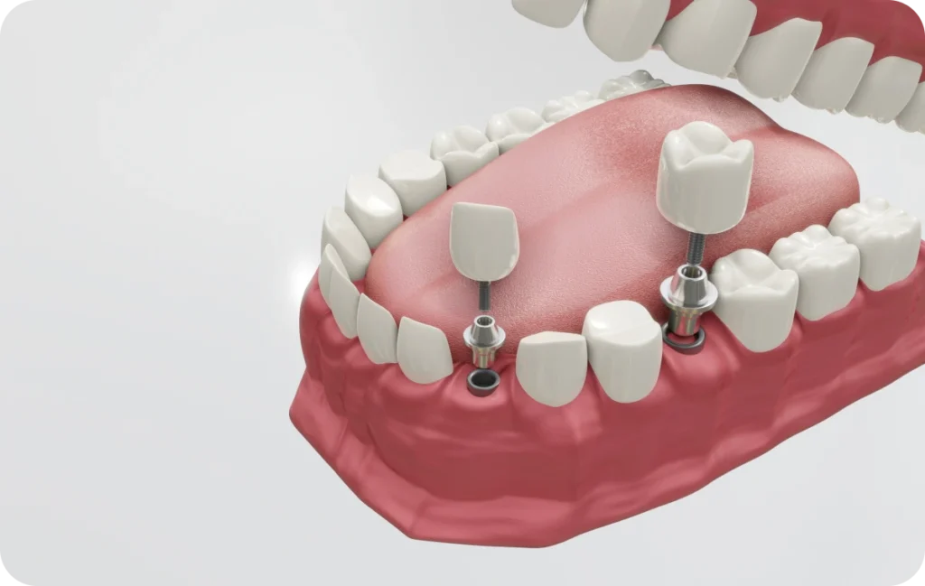 Implant dentaire immediat