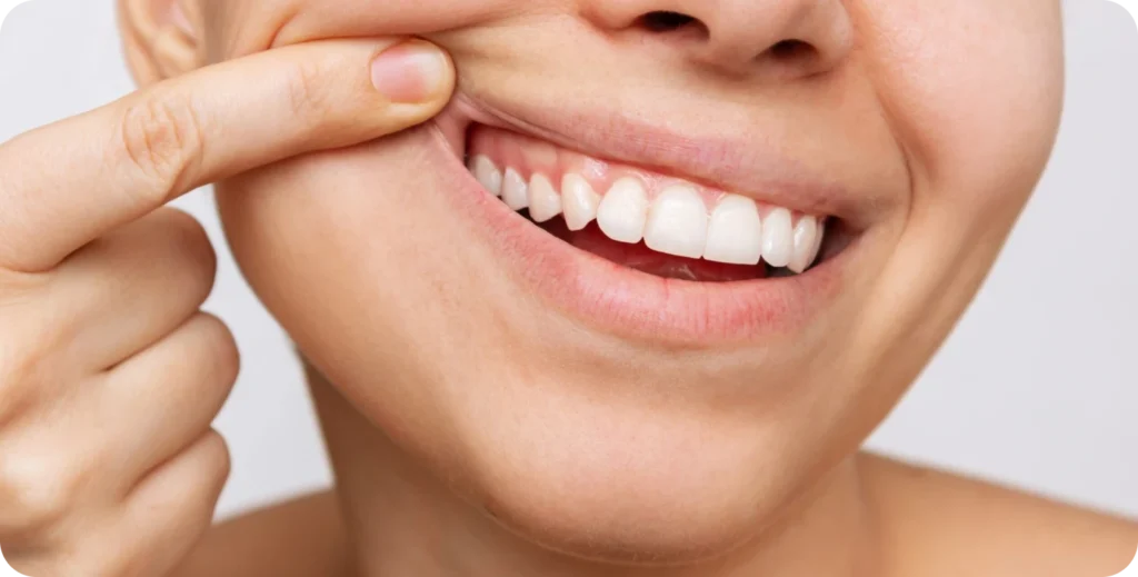 Soin des gencives / surfacage