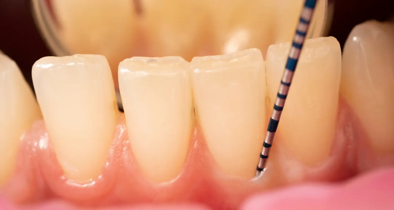 Module 1 : Parodontie clinique