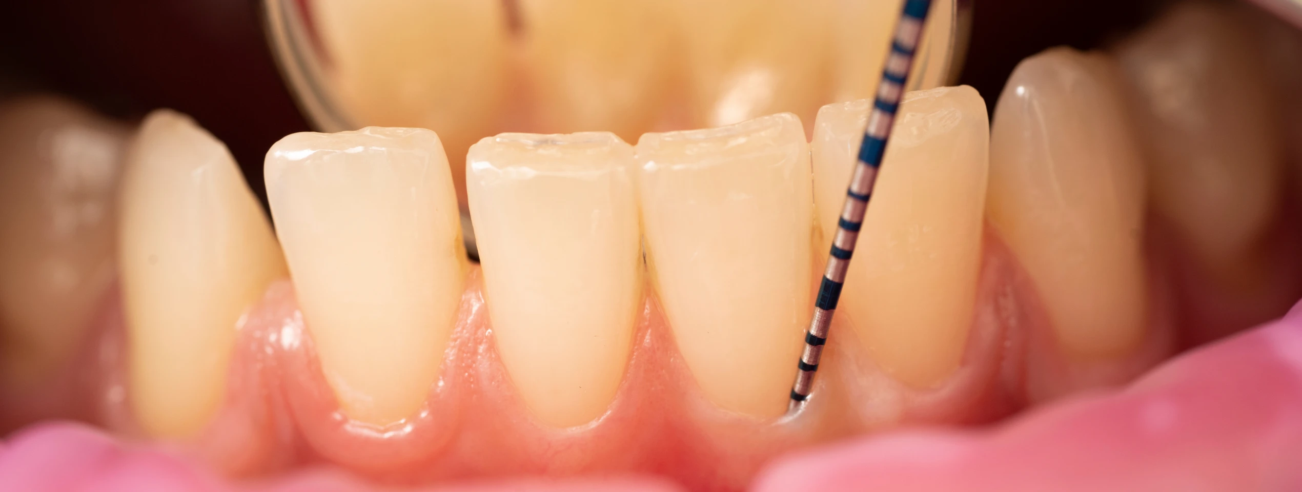 Cycle en Implantologie