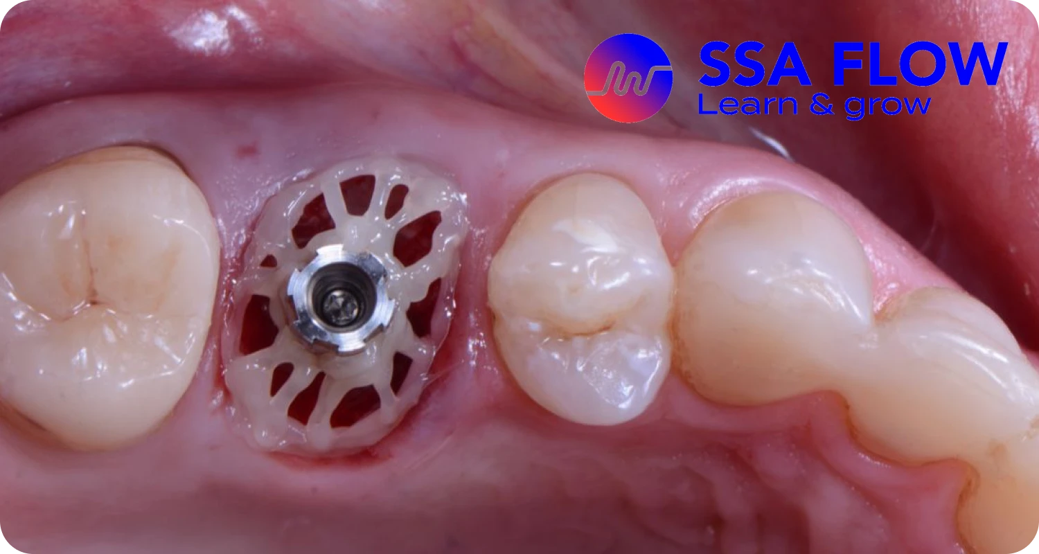 Master class en implantologie immédiate et concept SSA