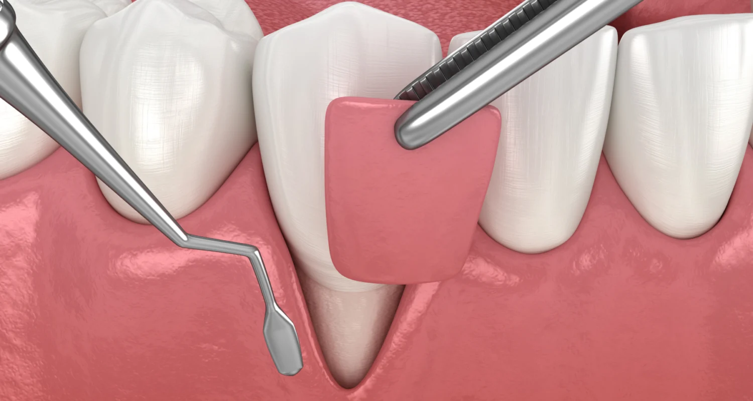 Module 2 : Parodontie Chirurgicale